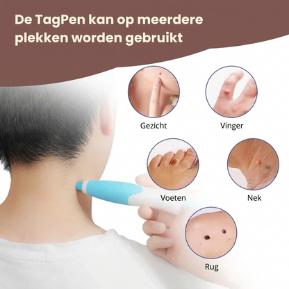 DermaClear™ - Skin Tag Verwijder Pen Kit