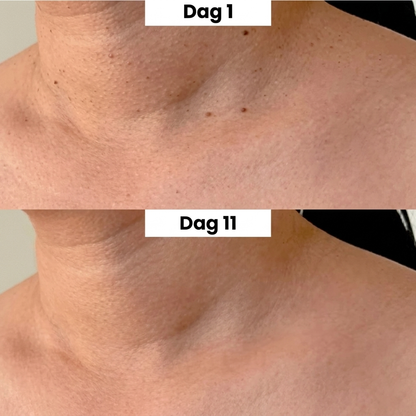 DermaClear™ - Skin Tag Verwijder Pen Kit
